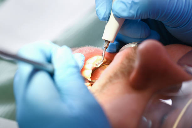 Best Dental Abscess Treatment in Appomattox, VA